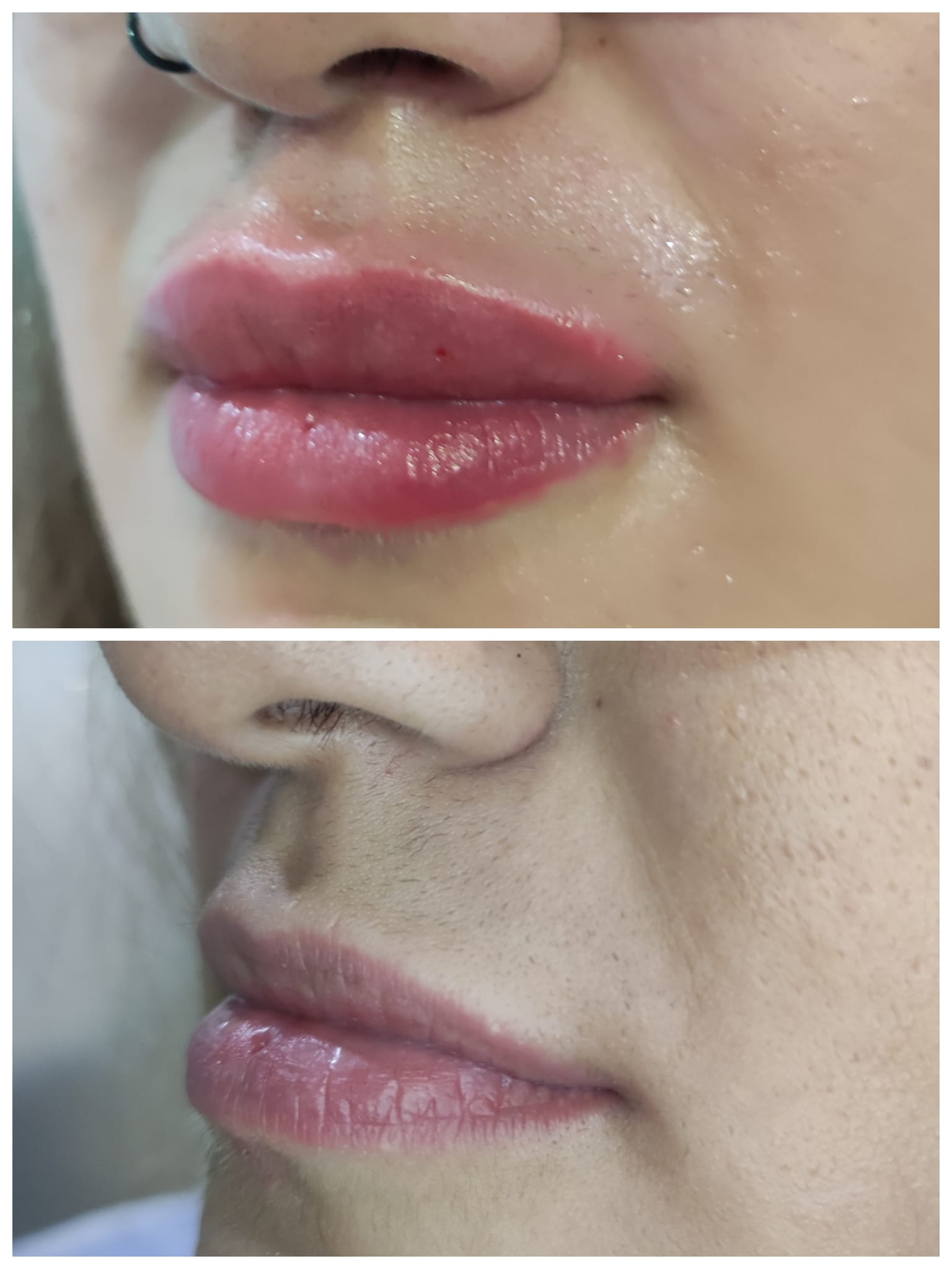 Aumento de labios antes y despues Elche Murcia Orihuela Alicante