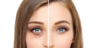Blefaroplastia sin cirugia Precio en Alicante