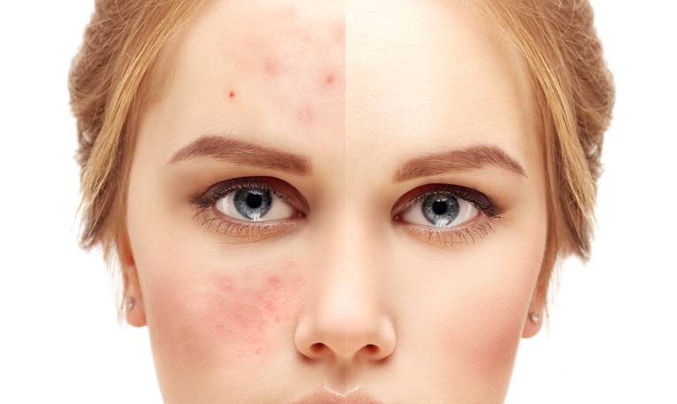Marcas del Acne Precio en Alicante