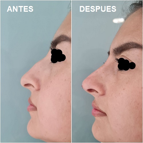 Correccion de nariz antes y despues Elche Murcia Orihuela Alicante