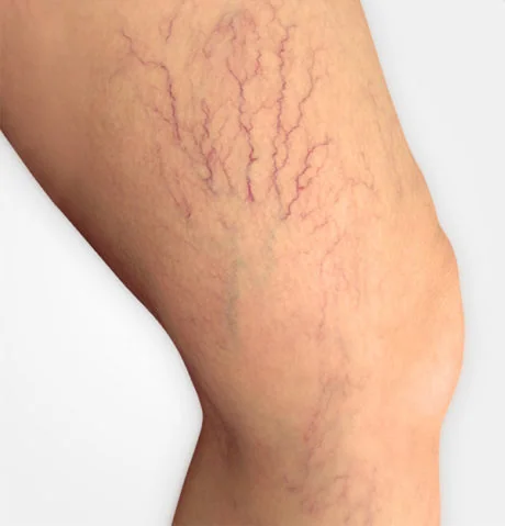 Varices y Arañas Vasculares — Stetia
